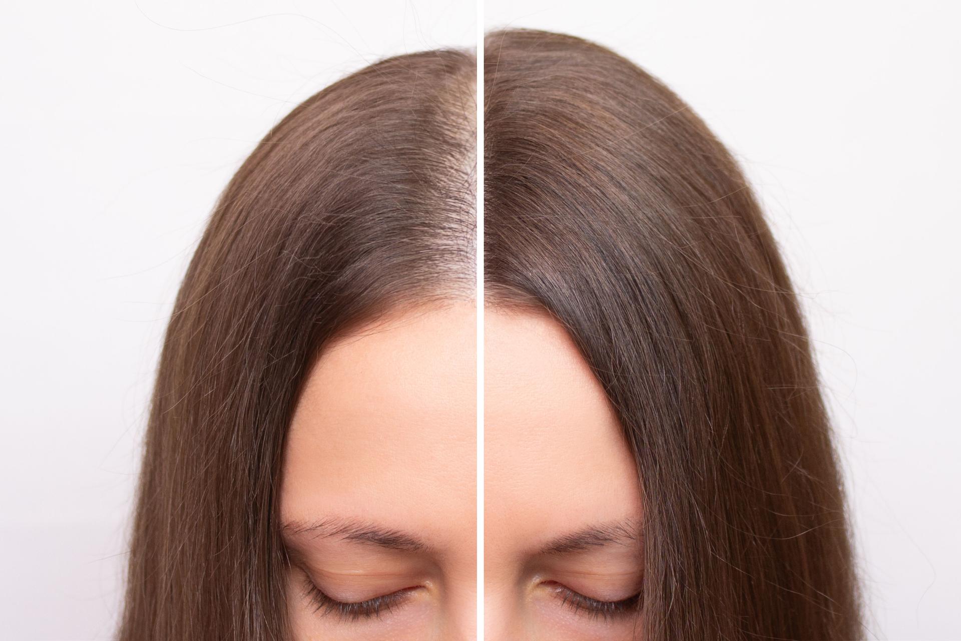 Before and after head shot of a young woman with a receding hairline on her forehead and parting